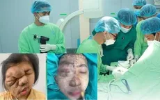 Phẫu thuật phức tạp tái tạo gương mặt cho cô gái 19 tuổi mang khối u suốt 17 năm
