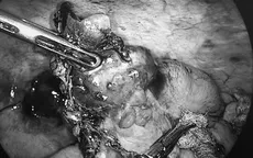 Phát hiện ung thư ruột thừa hiếm gặp khi mổ viêm ruột thừa