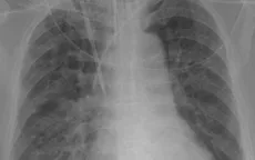 Cảnh giác với dị dạng nang tuyến phổi bẩm sinh ở trẻ nhỏ viêm phổi