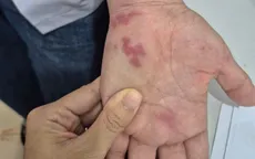 Nguy hiểm: Nhiễm vi khuẩn "ăn thịt người" sau khi bị vây cá đâm