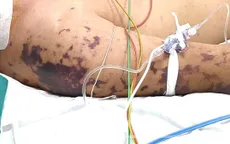 Nguy kịch vì vi khuẩn não mô cầu, dễ nhầm với liên cầu khuẩn lợn