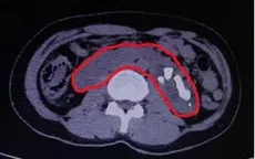 Xử trí thành công sỏi thận phức tạp trên nền thận móng ngựa hiếm gặp