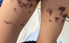 Cảnh báo bỏng hóa chất từ nước tẩy bồn cầu trong gia đình