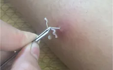 Chung tay phòng chống các bệnh nhiệt đới bị lãng quên