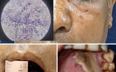 Nấm đen xâm lấn não: Bệnh hiếm nhưng cực kỳ nguy hiểm