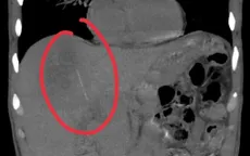 Nuốt tăm tre, người bệnh suýt mất mạng vì áp xe gan sâu