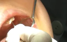 Từ một chiếc răng sâu, bệnh nhân đối mặt biến chứng hoại tử ngực nguy hiểm