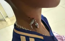 Gắp dị vật lưỡi câu mắc sâu vùng cổ cho bệnh nhi 13 tuổi