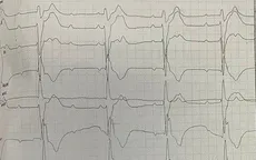 Tim đập hơn 200 nhịp/phút, huyết áp tụt sâu - người bệnh thoát "cửa tử" nhờ cấp cứu kịp thời