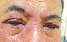 Cảnh báo tổn thương mắt do dị ứng thuốc