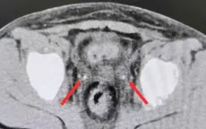 Cực kỳ hiếm: Sỏi niệu quản kẹt hai bên sau mổ viêm ruột thừa khiến bệnh nhi suy thận cấp