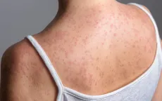 Bùng phát bệnh sởi ở London (Anh), hơn 60 trẻ bị nhiễm bệnh