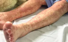 Đừng chủ quan với dị ứng thuốc