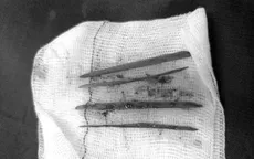 Nuốt 3 cây tăm, nữ bệnh nhân phải mổ cấp cứu