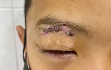 Nhiều trẻ chấn thương mắt do pháo dịp Tết