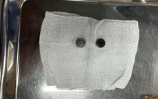 Cảnh báo trẻ nuốt dị vật nguy hiểm