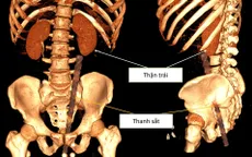 Dị vật xuyên thấu bụng do tai nạn hy hữu