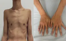 Phát hiện ca bệnh Marfan hiếm gặp ở nam thanh niên 18 tuổi