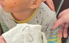 Cảnh báo tai nạn do lưỡi câu cá ở trẻ em