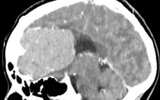 Vi phẫu nền sọ lấy khối u não "khổng lồ" cho bệnh nhân nữ