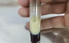 Viêm tụy cấp do tăng triglycerid: Cảnh báo nguy hiểm khi mỡ máu cao