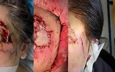 Ghép da cứu vùng mặt cho nữ bệnh nhân bị hoại tử sau tai nạn