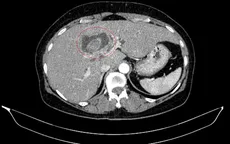 Hiếm gặp: Bệnh nhân mắc đồng thời hai ung thư nguyên phát
