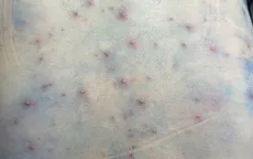 Cảnh giác với biến chứng nguy hiểm khi mắc bệnh thủy đậu