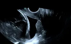 Giữ thai 50 ngày ngoạn mục khi cổ tử cung đã mở 3cm