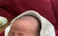 Trẻ sơ sinh mắc thủy đậu suy hô hấp nặng