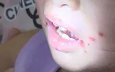 TP Hồ Chí Minh: Tay chân miệng tăng mạnh, sốt xuất huyết giảm