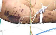 Cảnh giác viêm màng não do não mô cầu