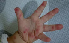Nhận biết sớm và xử trí đúng cách bệnh tay chân miệng tại trường học