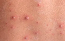 Hiểu đúng về bệnh thủy đậu để phòng ngừa hiệu quả