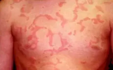 Cảnh báo nguy cơ từ việc lạm dụng corticoid trị mày đay