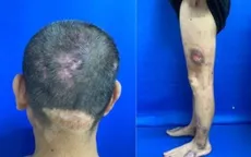 Viêm da tự tạo: Khi tổn thương da bắt nguồn từ rối loạn tâm lý