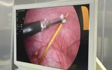 Tăm tre đâm thủng ruột, được phát hiện trong ca mổ ruột thừa