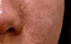 Da đỏ rát, nổi mụn sau vài ngày - cảnh báo dị ứng mỹ phẩm