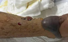 Cấp cứu thành công một ca bị rắn hổ bướm cắn, nguy cơ biến chứng nặng