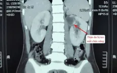 Phẫu thuật thành công dị tật hiếm: Thận đôi kèm niệu quản giãn lớn