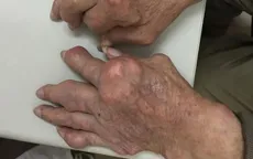 Cảnh báo gout mạn tính: Đừng để biến dạng khớp mới đi khám