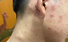 Thủy đậu gia tăng, phụ huynh cần đưa trẻ đi khám sớm