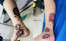 Ghép da tự thân - giải pháp hiệu quả trong điều trị bỏng và khuyết da