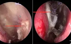 Viêm mũi xoang do nấm xâm nhập: Bệnh hiếm nhưng có thể đe dọa tính mạng