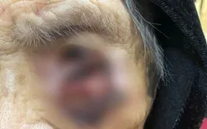 Cứu cụ bà 101 tuổi khỏi khối u da vỡ loét vùng mặt