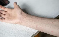 Xuất hiện ổ lây nhiễm sởi tại Singapore