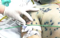 Liên tiếp các ca bệnh người trưởng thành mắc thủy đậu diễn tiến nặng