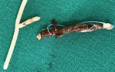 Lấy thành công vòng tránh thai lạc chỗ sau 25 năm