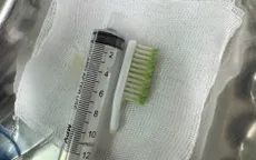 Gắp thành công bàn chải đánh răng trong dạ dày bệnh nhân