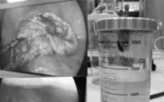 Cắt u buồng trứng gần 20cm cho bệnh nhi 13 tuổi